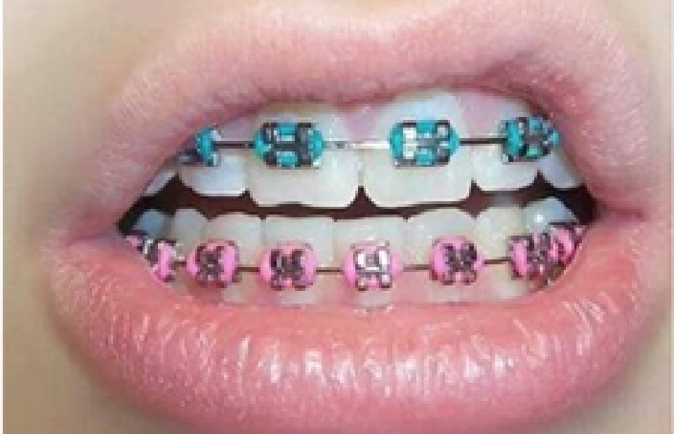 Types of Braces - Pros & Cons | Totara Orthodontists, Auckland