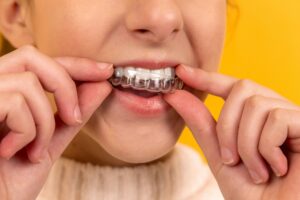 A post about the benefits of dental aligners.