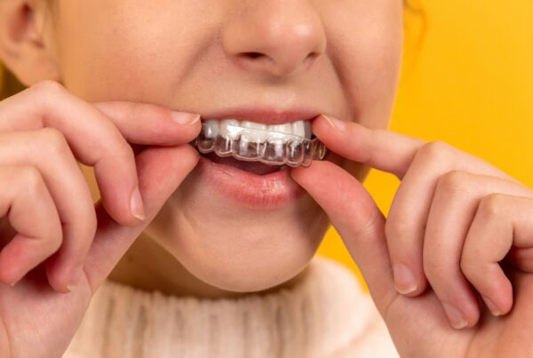 A post about the benefits of dental aligners.