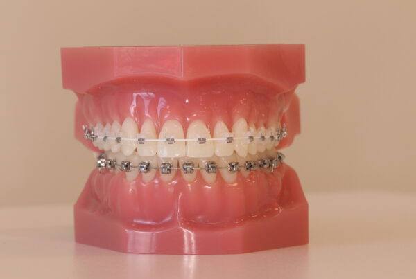 A post by Totara Orthodontics about the pros and cons of self-legating braces.