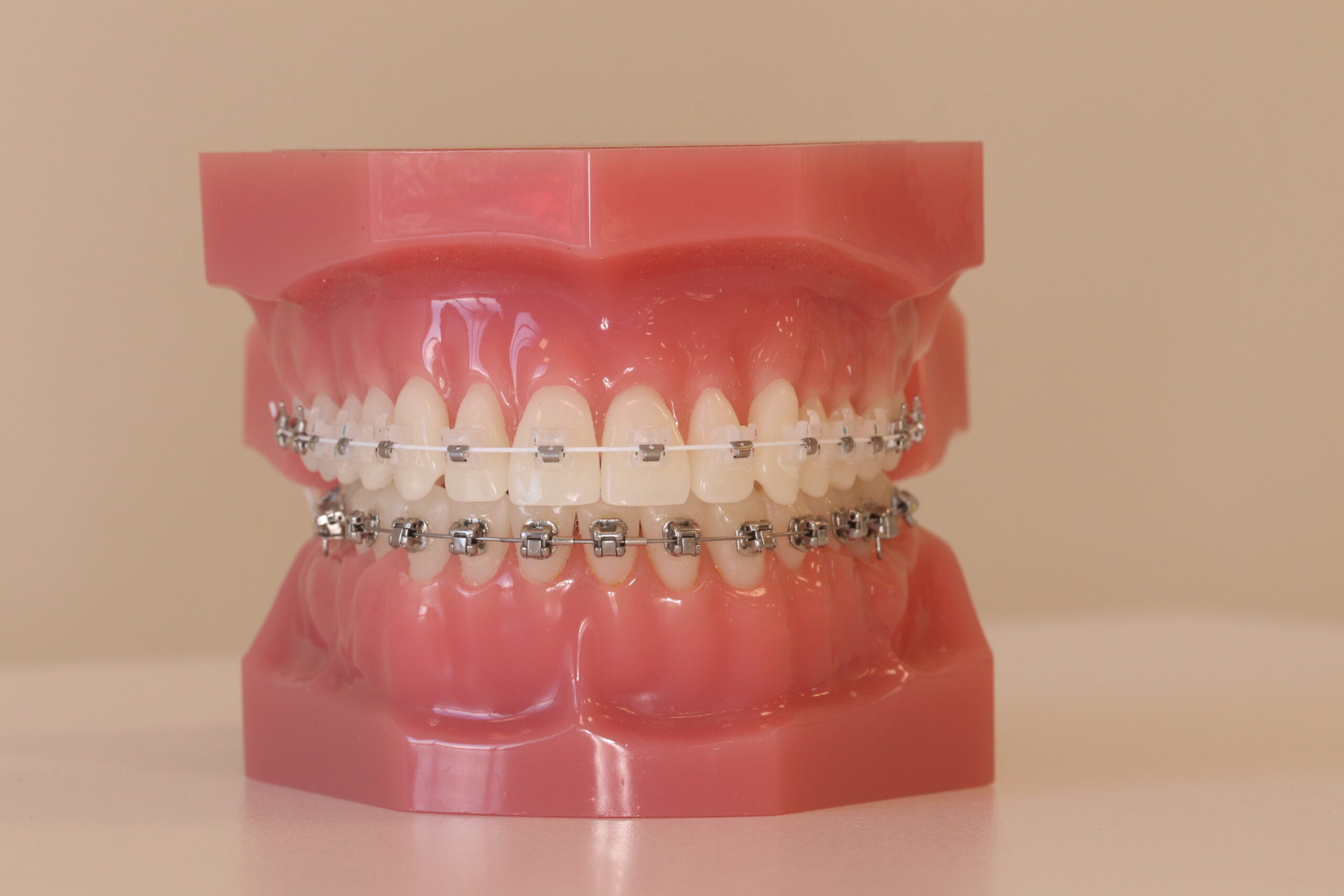 A post by Totara Orthodontics about the pros and cons of self-legating braces.